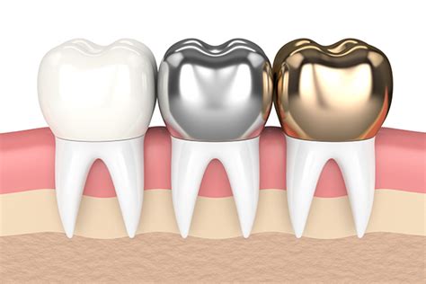 getting metal pre fabricated crown|metal dental crowns vs porcelain.